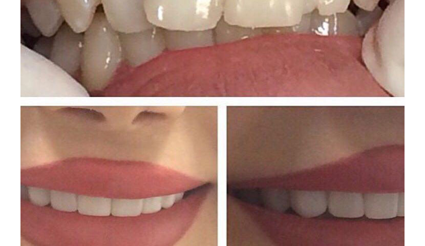 تصویر قبل و بعد کلینیک دندانپزشکی دردیس در سعادت آباد